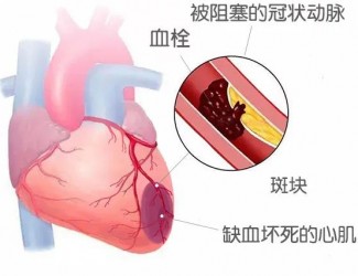 血栓的形成原因及后果，如何預(yù)防血栓導(dǎo)致的疾病